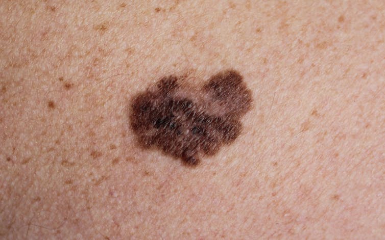 Melanoma on light skin