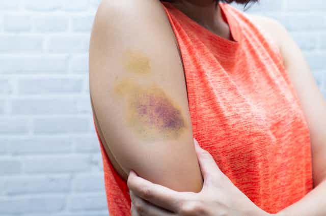 person cradles arm with bruise on it