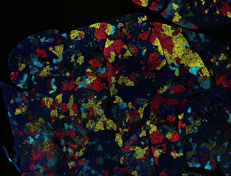 Microscopy image of pancreas tumor with multicolored cell subgroups