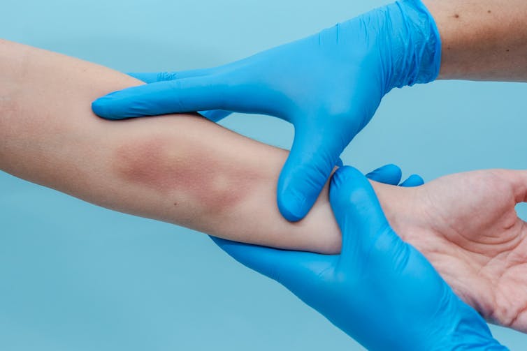 Hands in blue gloves examine arm showing bruising