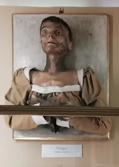 How to Solve Our Mental Health Crisis By Matthew Smith Wax head-and-shoulders model of a woman with pellagra