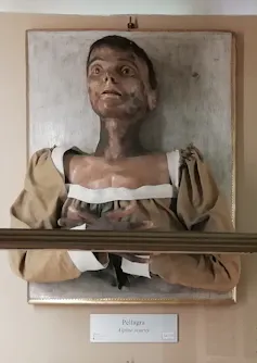 Wax head-and-shoulders model of a woman with pellagra