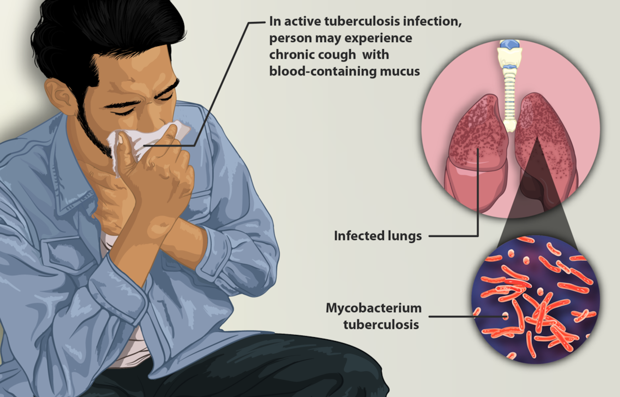 Indonesia perlu tingkatkan pendanaan tiga kali lipat untuk kendalikan tuberkulosis – inilah awal yang harus dilakukan