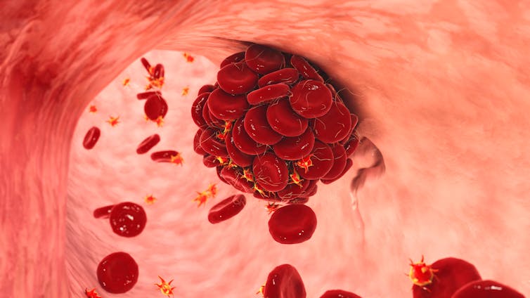 Un dibujo digital de un coágulo de sangre que se forma en el cuerpo.