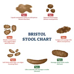 A chart displays the different types of poos as categorised by the Bristol Stool Chart.