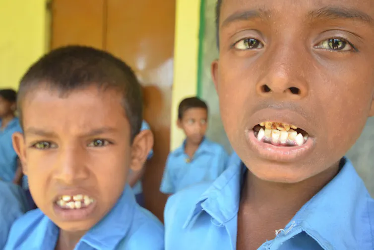 Indian children showing teeth affected by fluorosis.