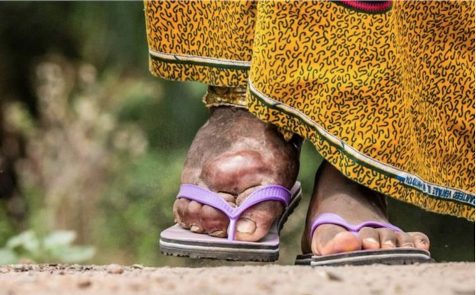 Photo of a person's feet, one of which is swollen,