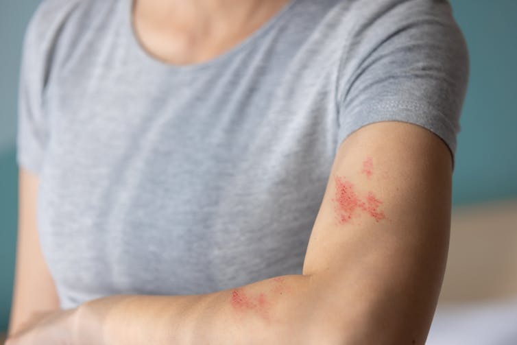 Patches of the shingles rash on a woman's arm.