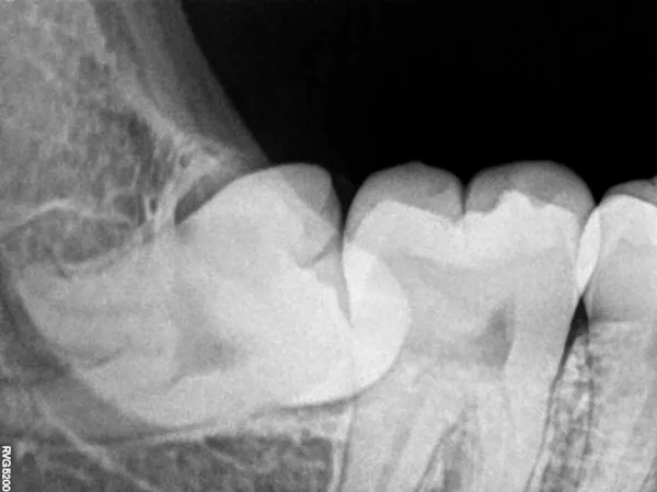 Una radiografía que muestra un molar posterior que crece de lado hacia su vecino.