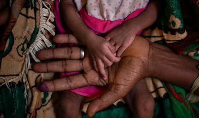 The hands of a malnourished child lie in the palm of an adult's hand