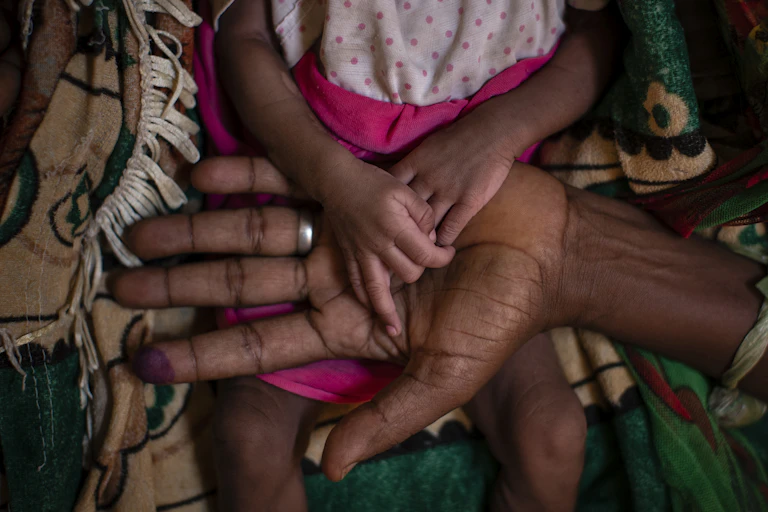 The hands of a malnourished child lie in the palm of an adult's hand