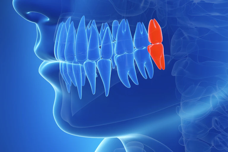 Digital Illustration of human jaw. Third molar in back of mouth is highlighted in red.