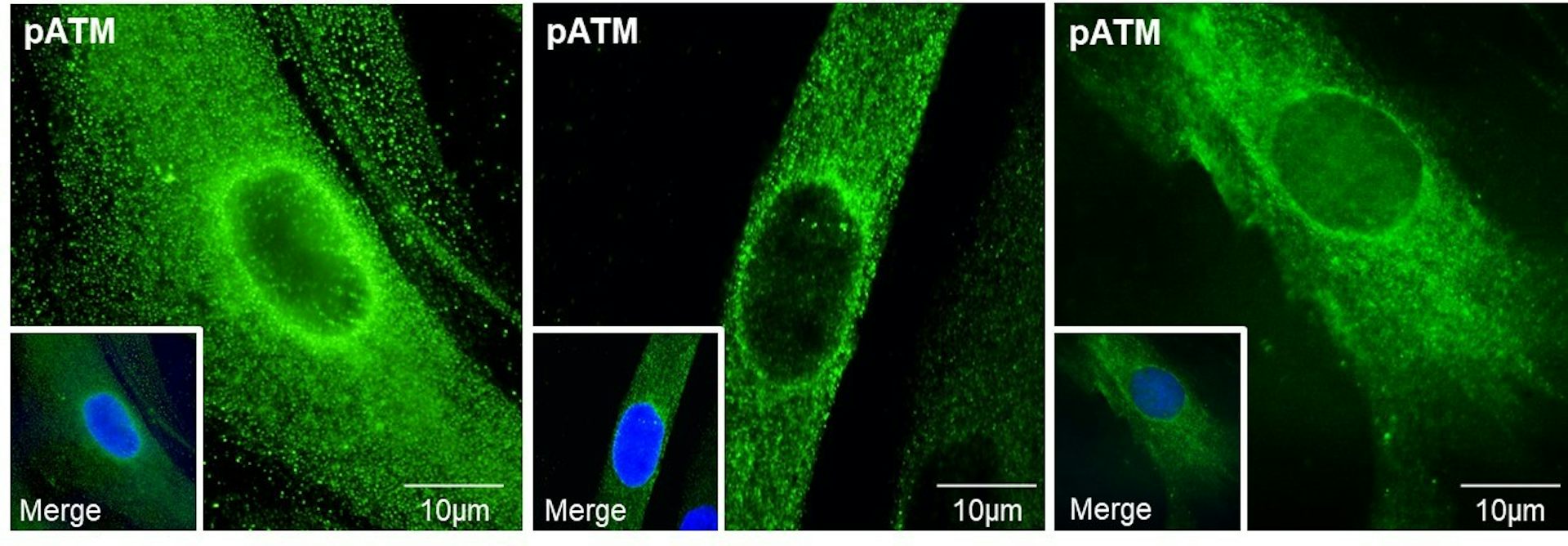 Image de microscopie montrant grâce à l’immunofluorescence des exemples représentatifs de couronnes périnucléaires formées par la protéine ATM autour du noyau de cellules (fibroblastes) de peau de patients atteints par la maladie d’Alzheimer.
