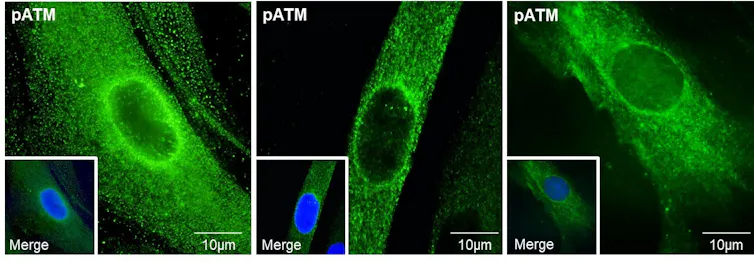 Image de microscopie montrant grâce à l’immunofluorescence des exemples représentatifs de couronnes périnucléaires formées par la protéine ATM autour du noyau de cellules (fibroblastes) de peau de patients atteints par la maladie d’Alzheimer.