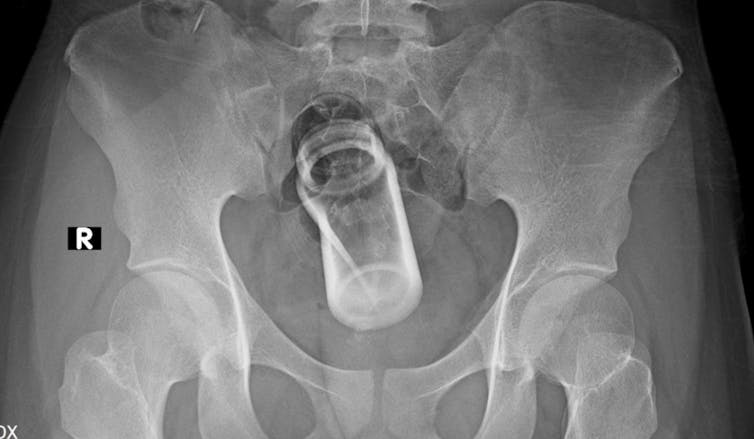 X-ray showing a foreign body in a patient's rectum.