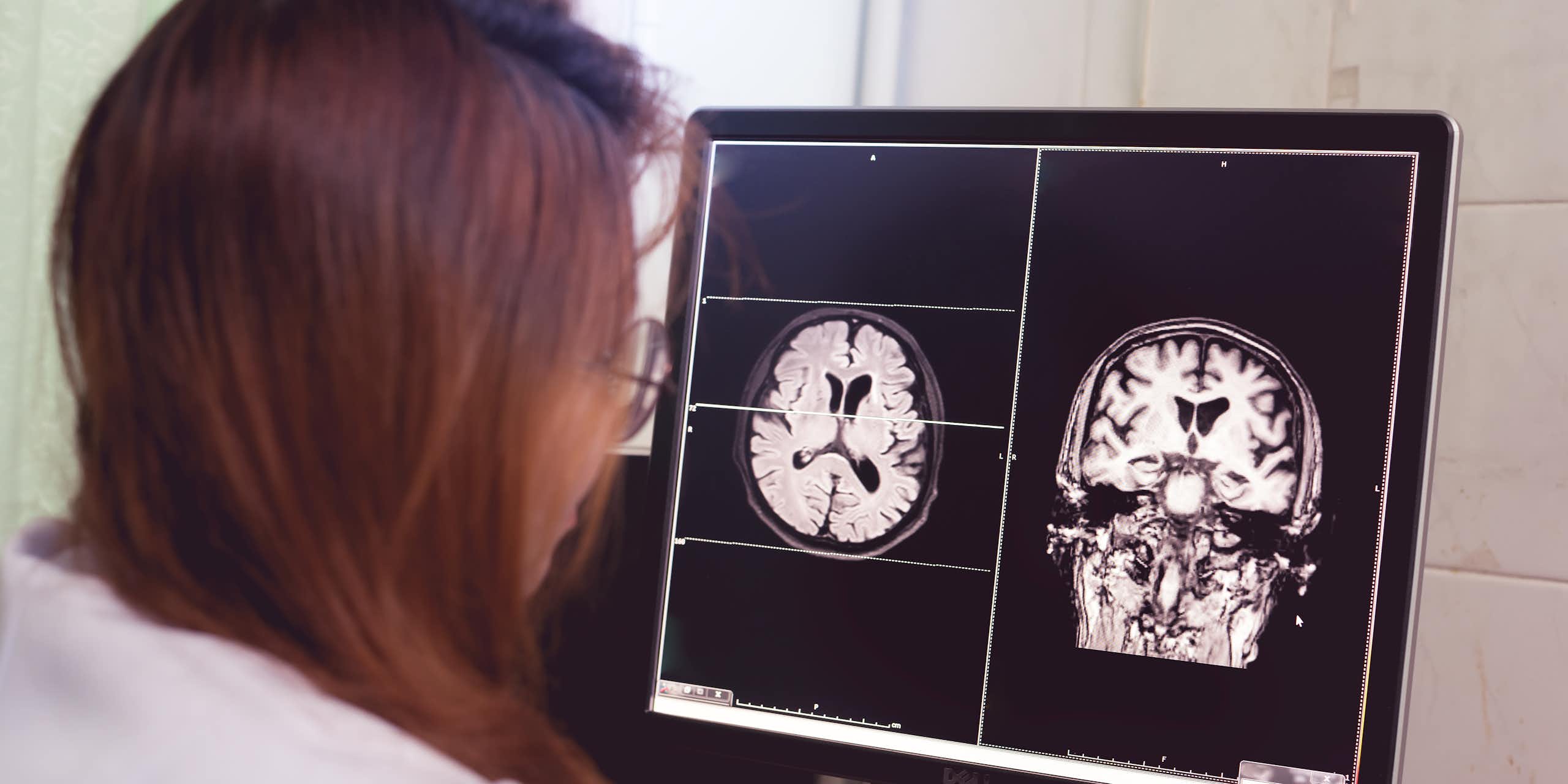 A female doctor wearing a white lab coat looks at brain scans on a computer screen.