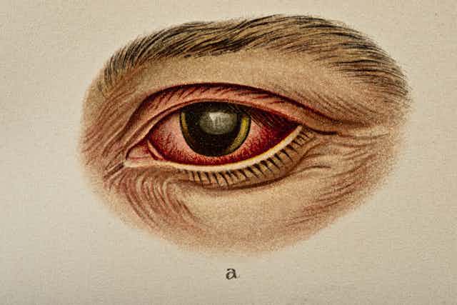 Illustration of Hereditary Syphilis of the Human Eye