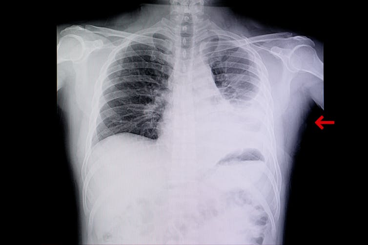 Chest X-ray showing a white shadow on the lung
