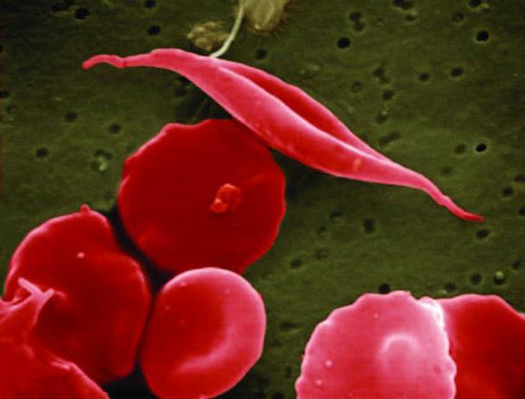 Photo de globules rouges. Certains présentent une forme normale, d’autres une forme de faucille caractéristique de la drépanocytose.