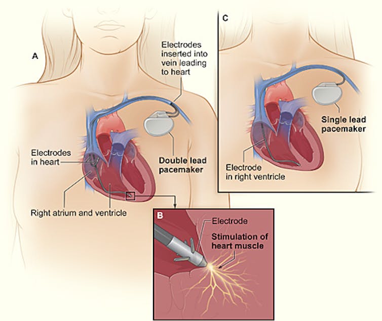 Diagram of cross-section of heart with implanted pacemaker