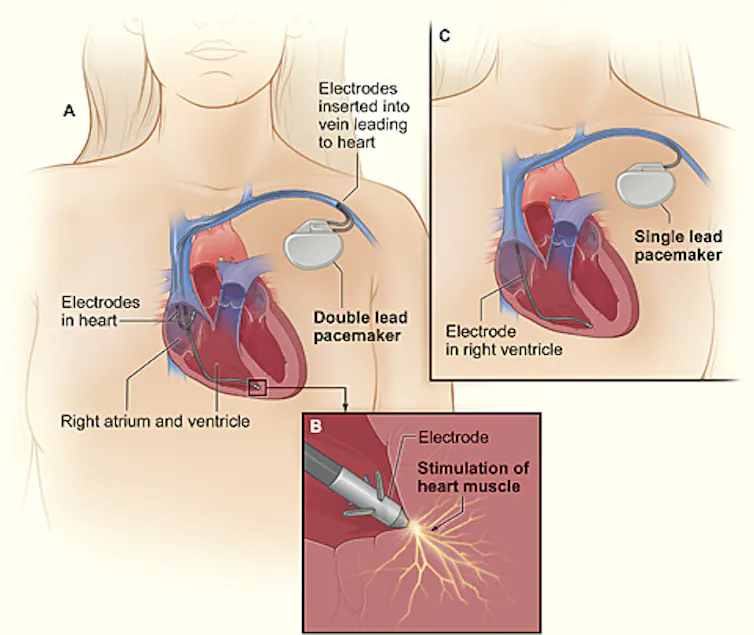 Schéma en coupe du cœur avec un stimulateur cardiaque implanté