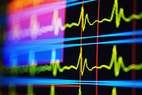 How do pacemakers and defibrillators work? A cardiologist explains how they interact with the electrical system of the heart