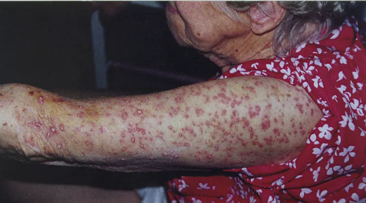 Women with multiple blisters on arm from red important fire ants bites