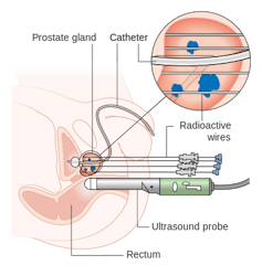 Diagram showing the insertion of high-dose radioactive wires to treat prostate cancer