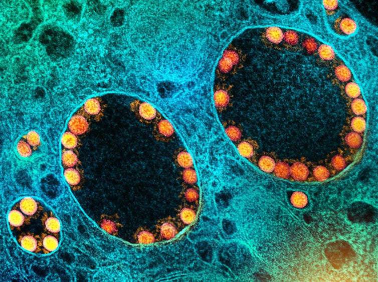 Microscopy image of SARS-CoV-2 virus particles lining the a few vesicles in a cell