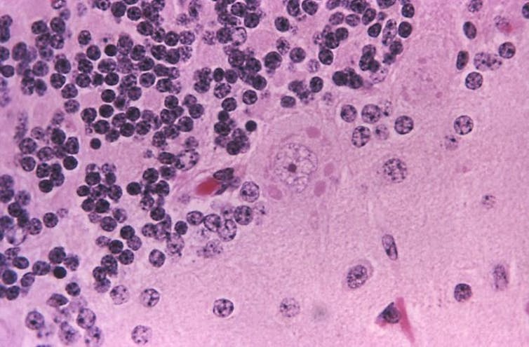 Microscopy image of clusters of dark circles called Negri bodies against a background of pink brain tissue