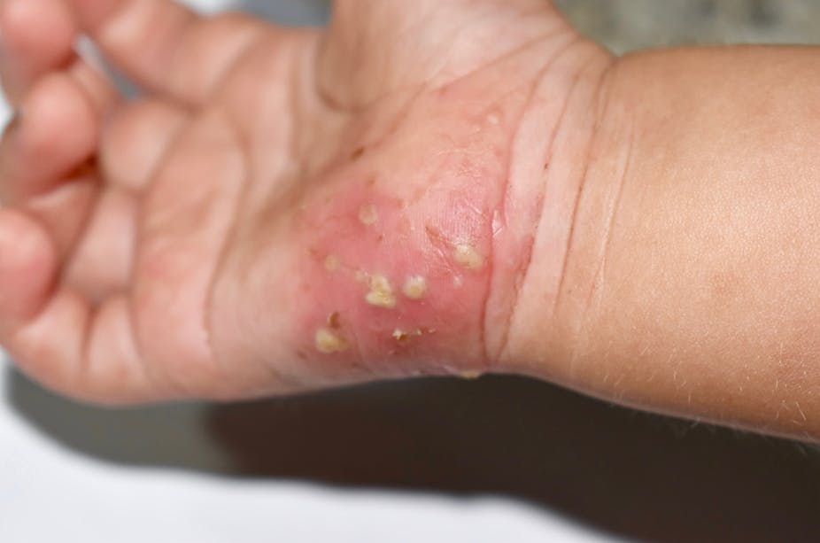 A child with a rash on their hand caused by scabies.