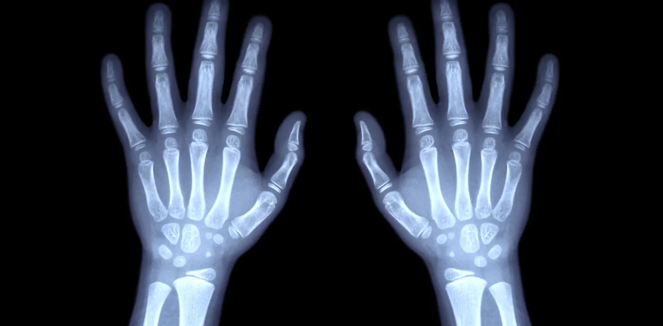Estimer l’âge d’un mineur par radiographie peut se révéler discriminatoire Estimer l’âge d’un mineur par radiographie peut se révéler discriminatoire