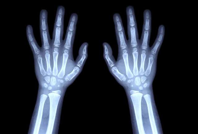 Radiographie montrant les os des deux mains d'un enfant
