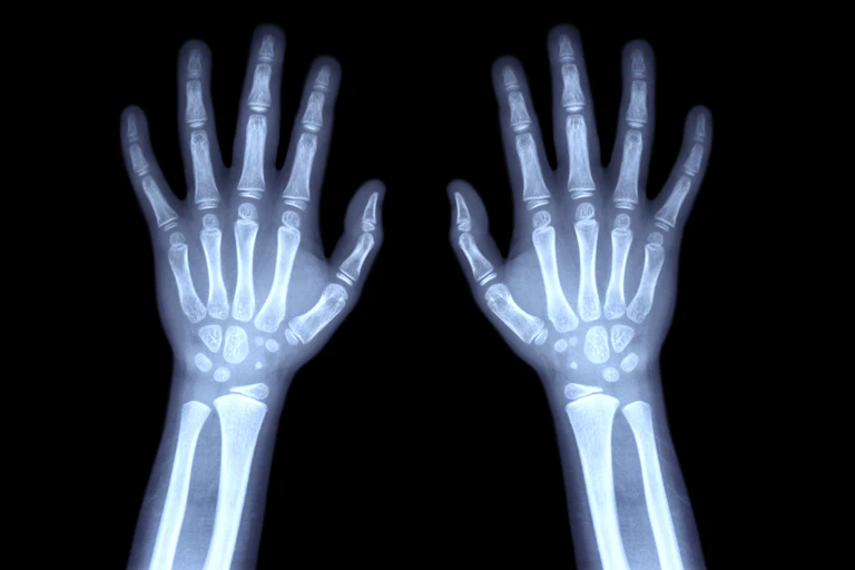 Radiographie montrant les os des deux mains d'un enfant