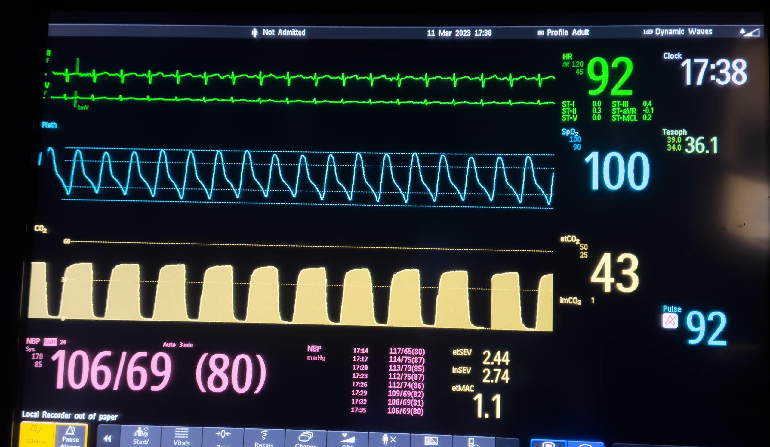 A hospital monitor showing body signals. 