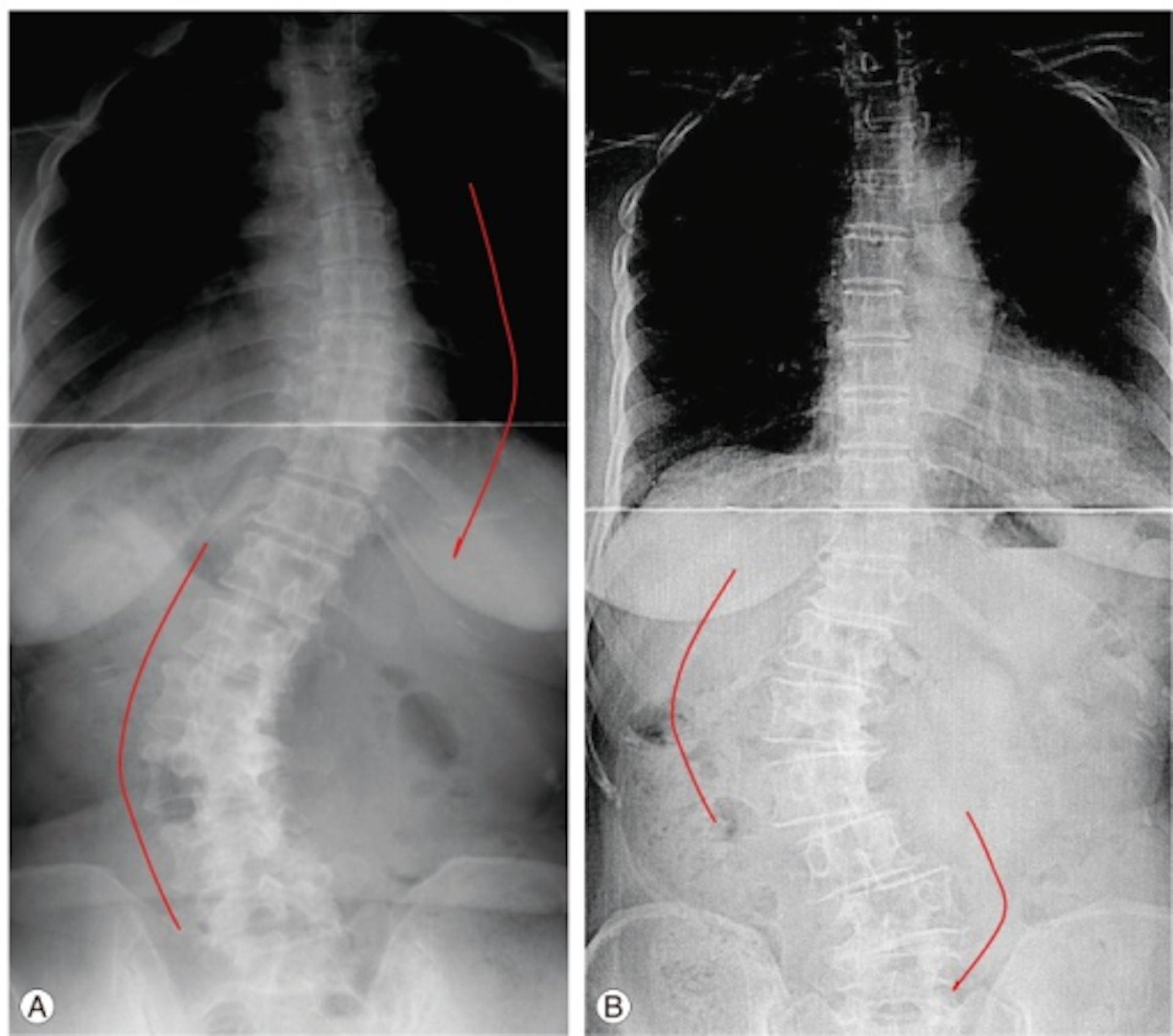 Breaking The Curve: A Call For Comprehensive Scoliosis Awareness And Care