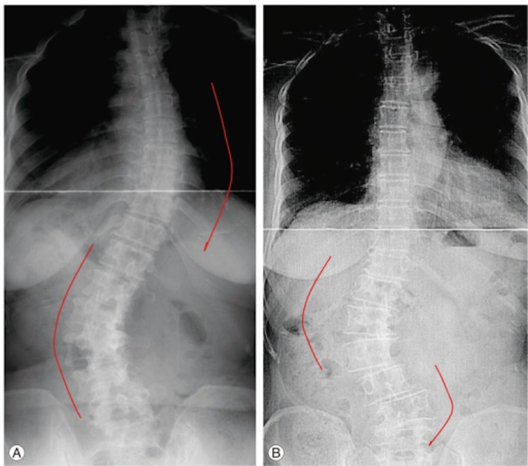 X-ray images of two human torsos showing signs of scoliosis