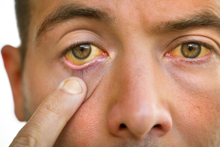 A man with jaundice pulls down one eyelid.