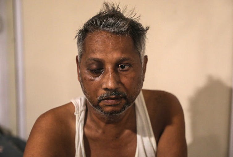 A patient with suspected black fungus infection in India.