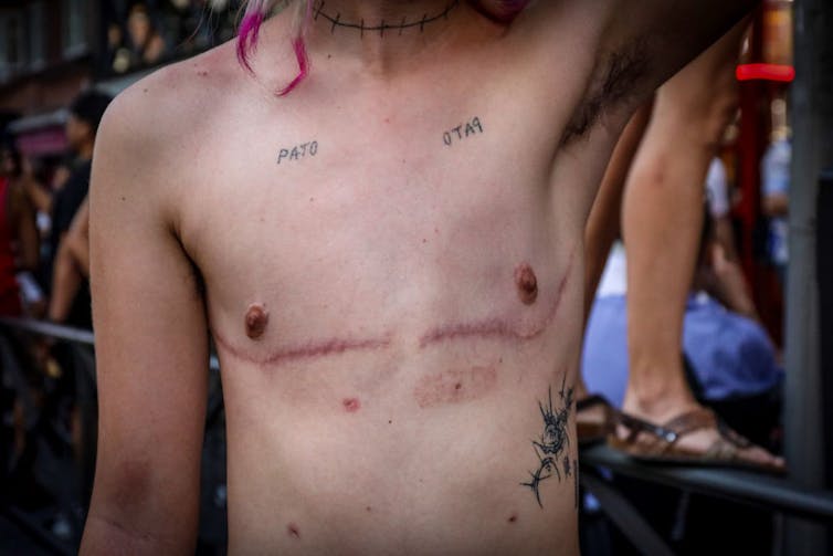 Shirtless young person with scars from a mastectomy visible.