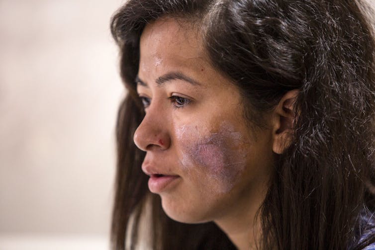 woman's face with purple discolouration on cheek from frostbite injury