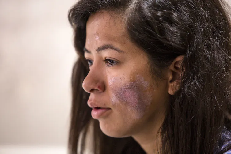 woman's face with purple discolouration on cheek from frostbite injury