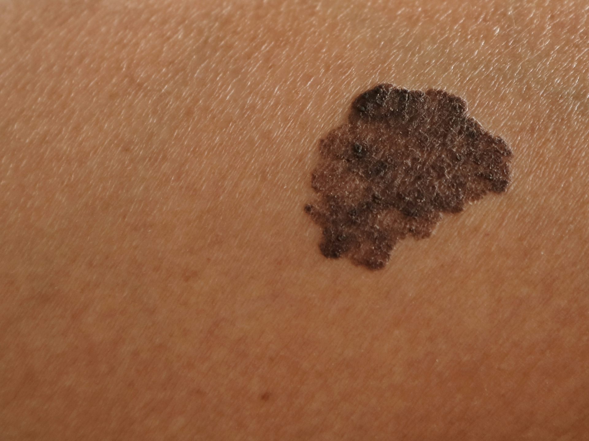 A irregular mole.
