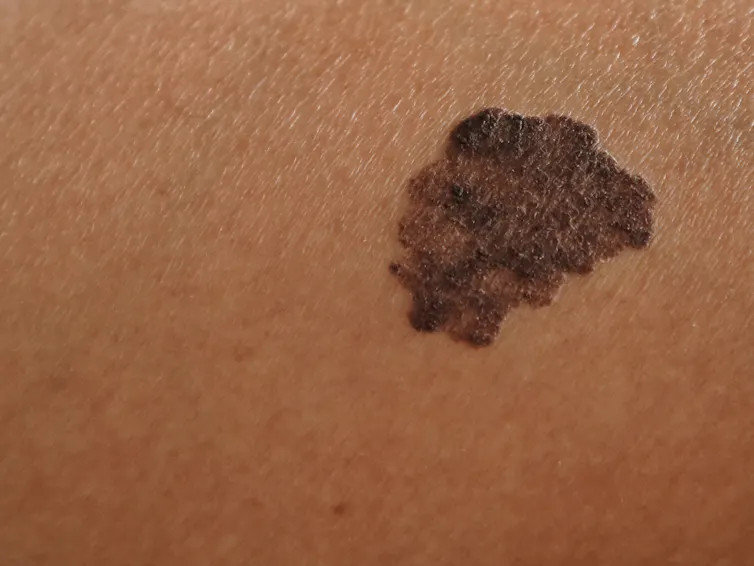 A irregular mole.