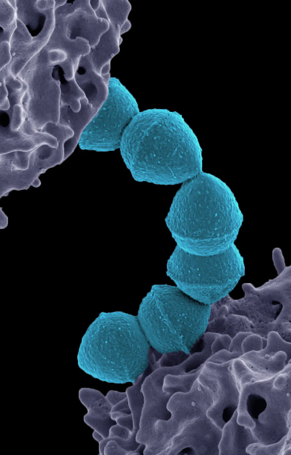 Strep A Plus Strep A explainer: Why invasive cases are increasing, how it spreads ...