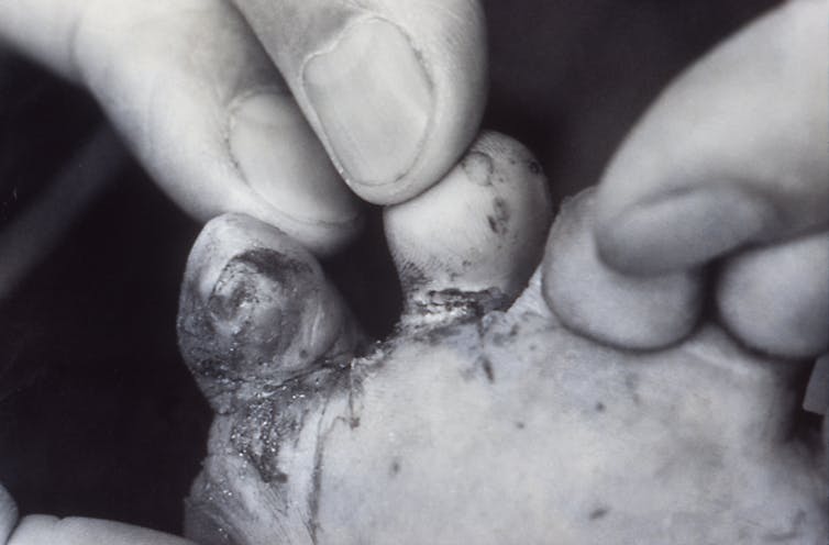 The bottom of the child's feet shows open lesions in the toes