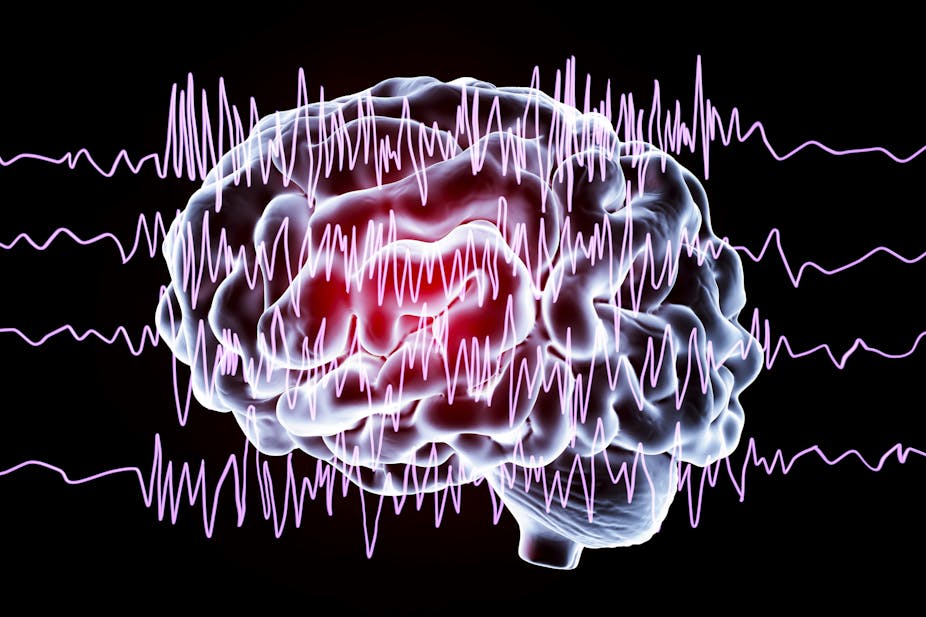 Computer illustration of a brain and brain waves representative of epilepsy.