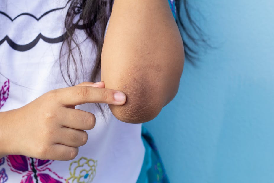 A girl points to a darkened patch of skin on her elbow, caused by acanthosis nigricans.