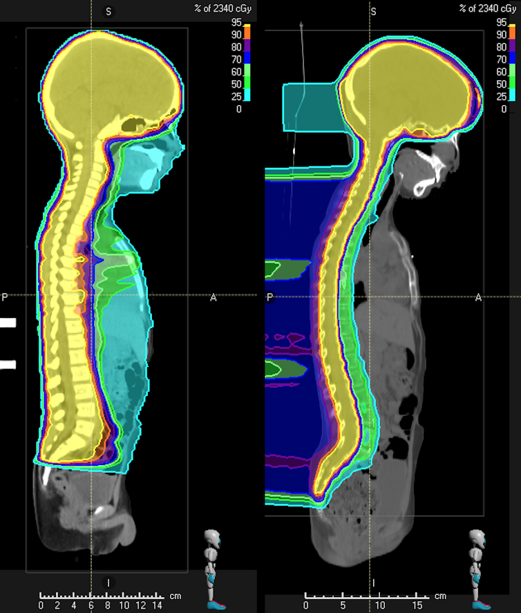 Plans d’irradiation pour le cancer du cerveau