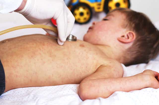 A child with measles lying on his back.